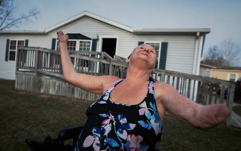 Betty-Lou throws her hands up in the air outside her Augusta, Michigan home. “Dave deserves something better than this,” she says laughing. Betty-Lou has been slowly losing parts of her body since she was 25 to the smoking-related Buerger's disease, which causes capillary atrophy in the extremities.